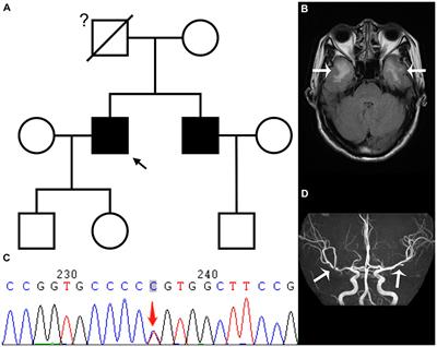 Treatment options for patients with CADASIL and large-scale cerebral infarction: mechanical thrombectomy and antiplatelet therapy—A case report